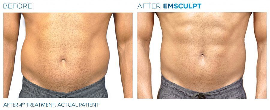 Body Contouring with Emsculpt Before and After Photos one