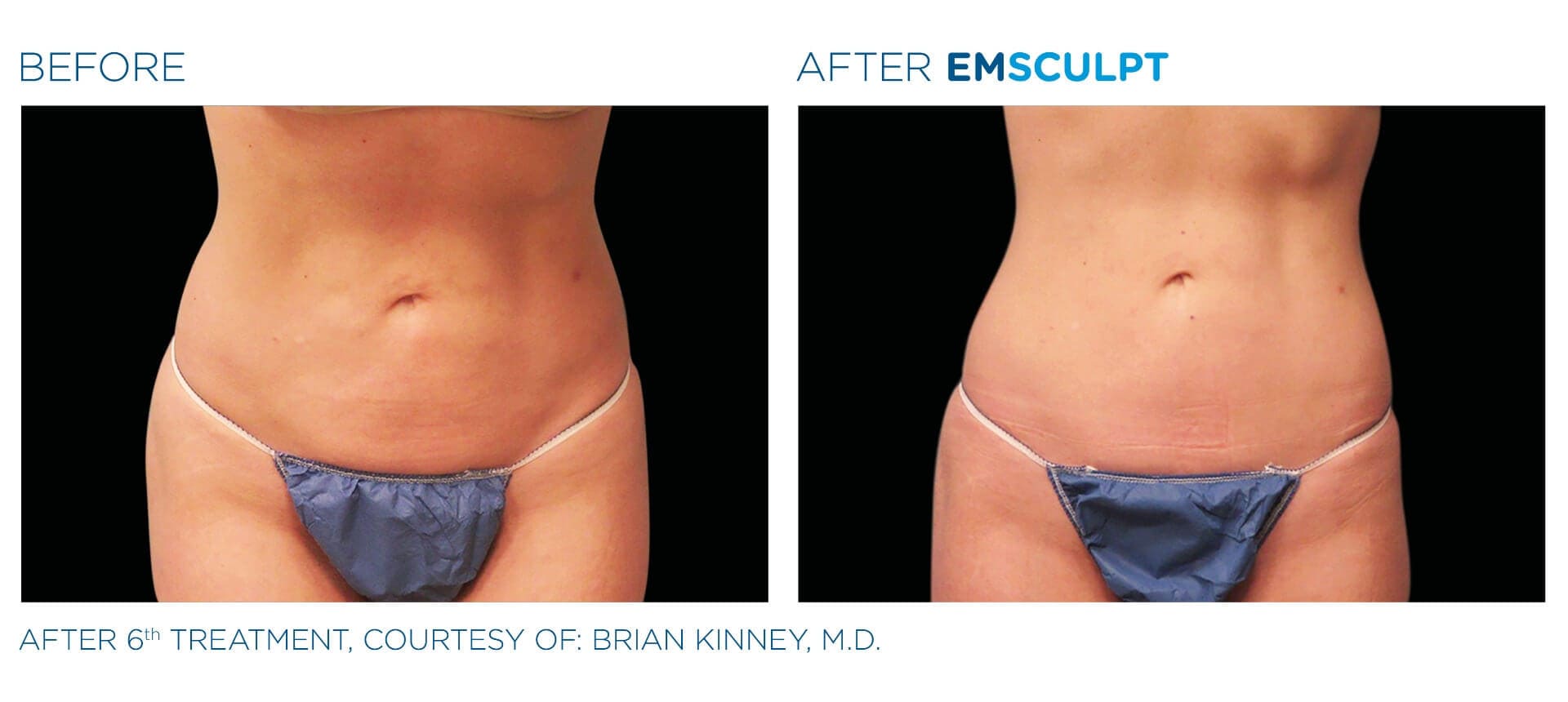 Body Contouring with Emsculpt Before and After Photos women two