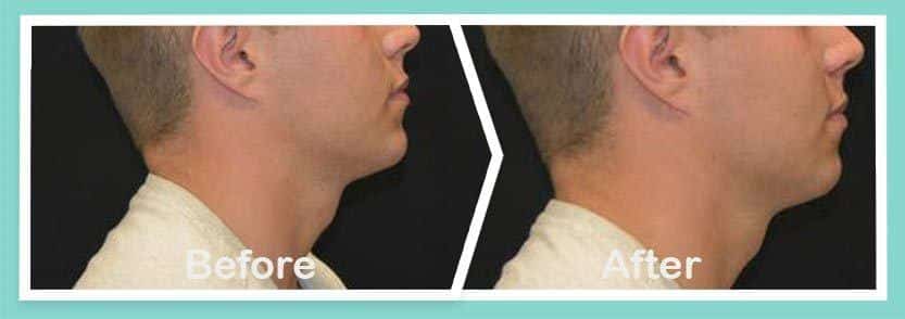 Chin jawline before and after-Treatment result photos in South Kingstown RI & Newport, RI | SeaMist MedSpa