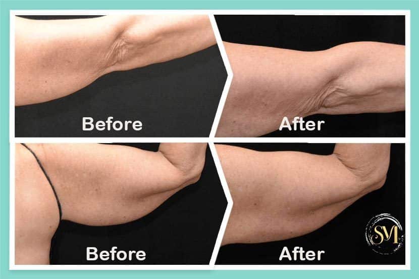 Coolsculpting before and after-Treatment result photos in South Kingstown RI & Newport, RI | SeaMist MedSpa
