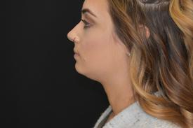 Kybella before-after Treatment in South Kingstown RI & Newport, RI | SeaMist MedSpa