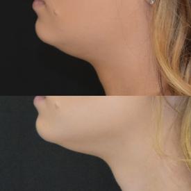 kybella before-after Treatment in South Kingstown RI & Newport, RI | SeaMist MedSpa