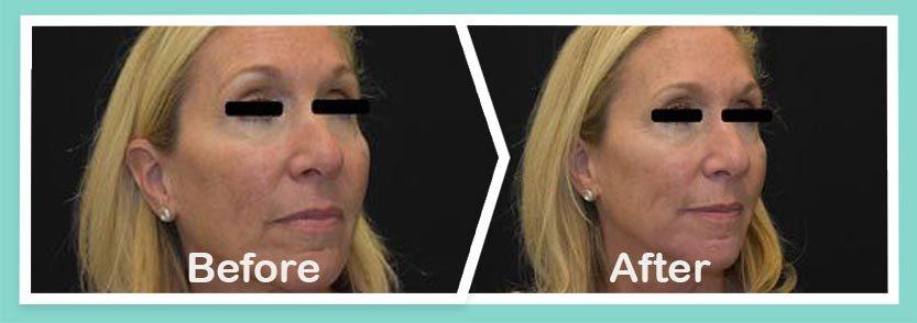 Lower-face-before-and-after-treatmen result Photos in South Kingstown RI & Newport, RI | SeaMist MedSpa
