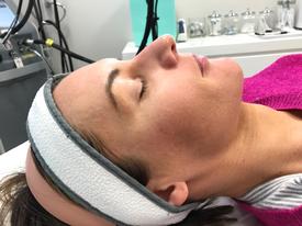 Microneedling-before-after-Treatment in South Kingstown RI & Newport, RI | SeaMist MedSpa
