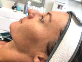 Microneedling-before-after-Treatment in South Kingstown RI & Newport, RI | SeaMist MedSpa