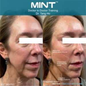 MINT-PDO Before & After Treatment Photos in South Kingstown RI & Newport, RI | SeaMist MedSpa