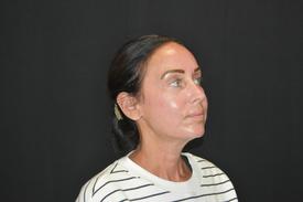 RF-Microneedling-before-after eight Treatment in South Kingstown RI & Newport, RI | SeaMist MedSpa