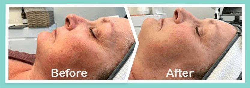 Under eyes Before and After-Treatment Photos in South Kingstown RI & Newport, RI | SeaMist MedSpa