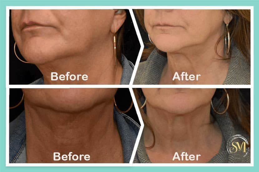 How To Get Rid Of A Double Chin Kybella two