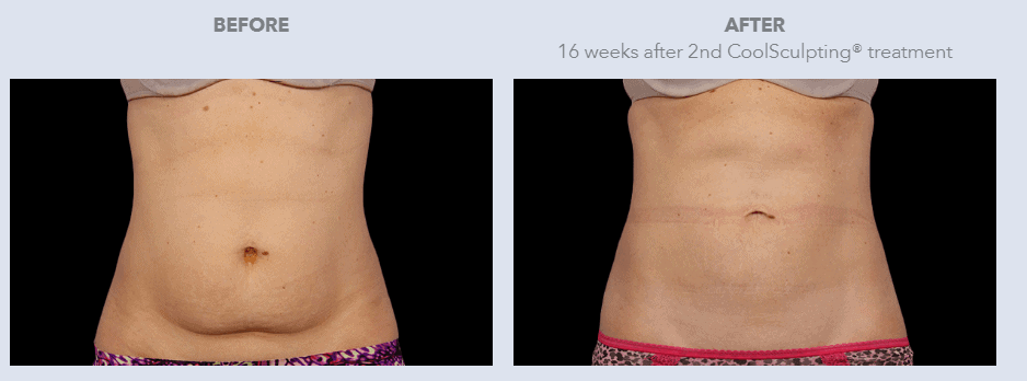 What is CoolSculpting® Before and After Pictures Seamist Med Spa