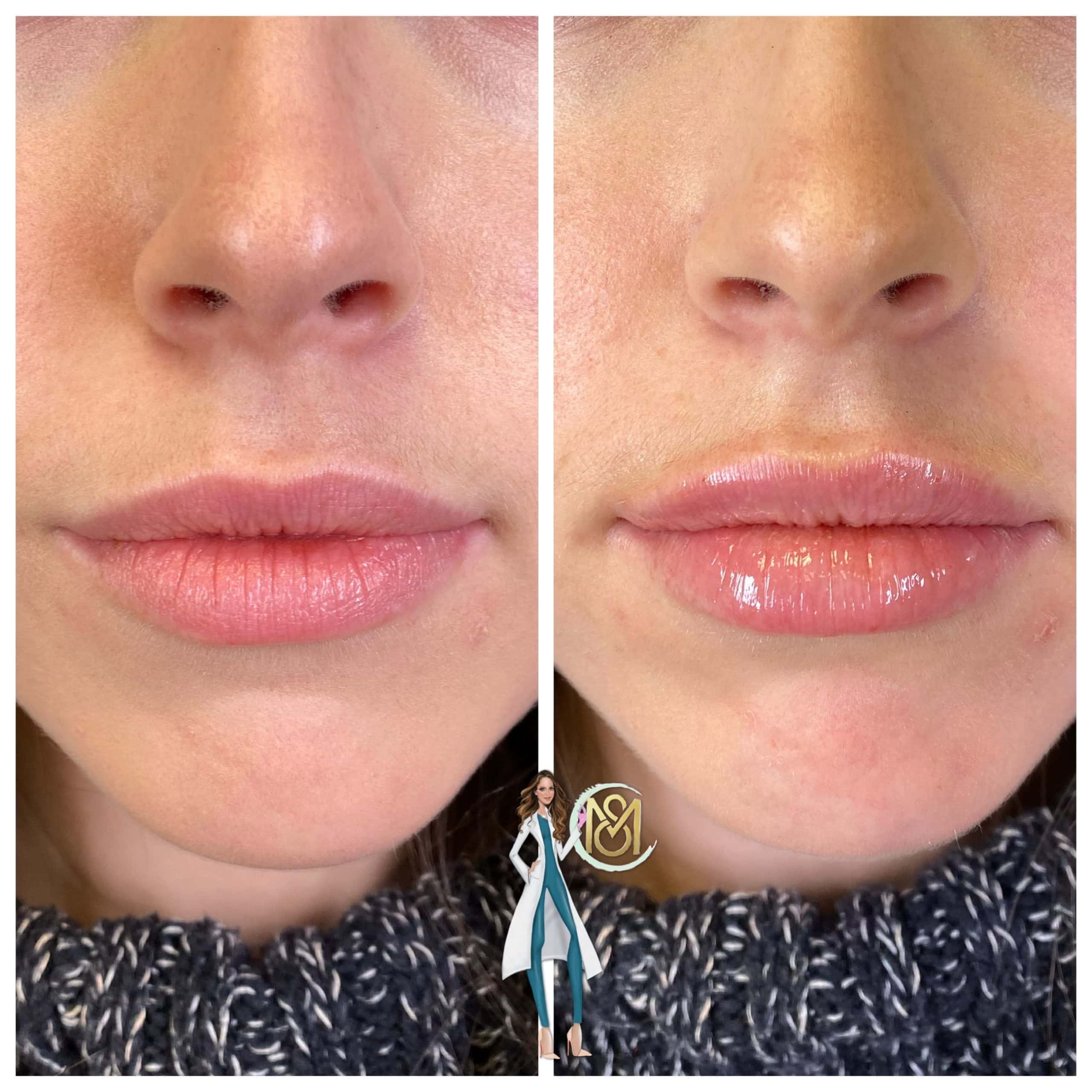 Dermal Filler - Lips 16