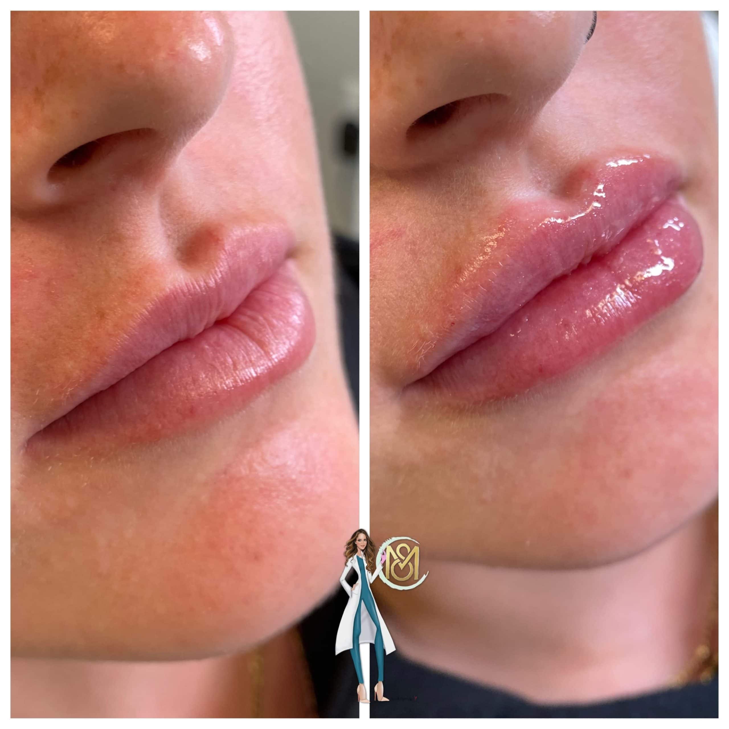 Dermal Filler - Lips 2