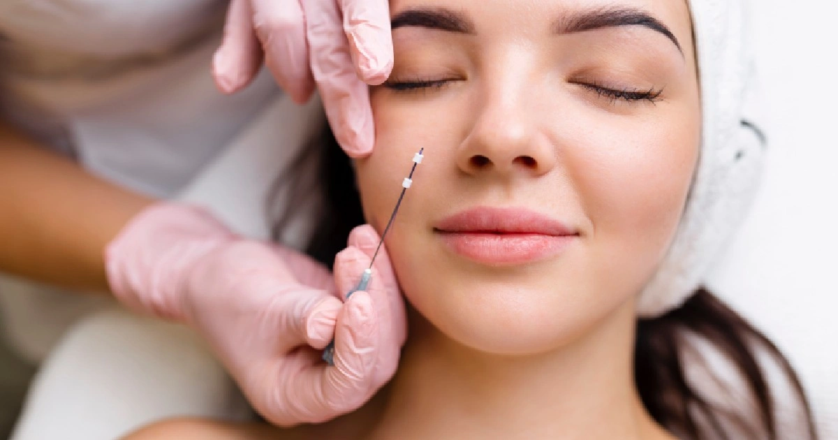 Women receiving Mint PDO Thread Lift in Newport