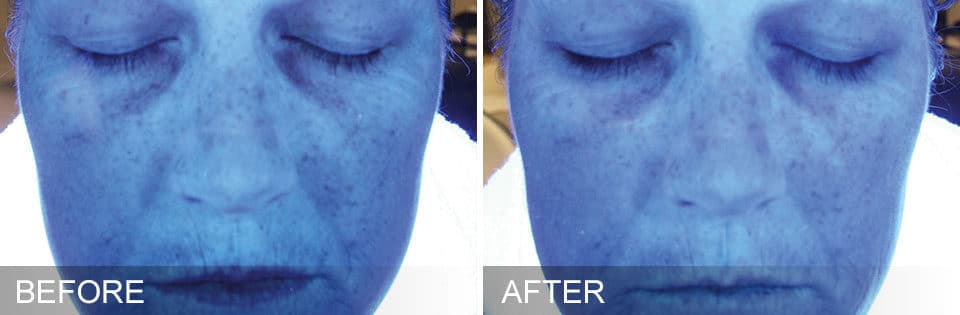 Hydrafacial Before & After Treatment Photos in South Kingstown RI & Newport, RI | SeaMist MedSpa