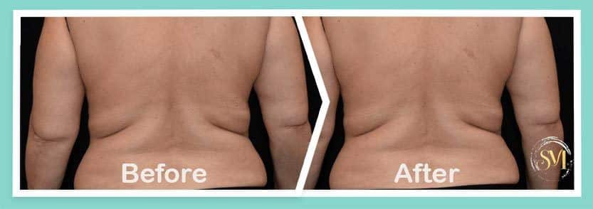 Coolsculpting before and after-Treatment result photos in South Kingstown RI & Newport, RI | SeaMist MedSpa