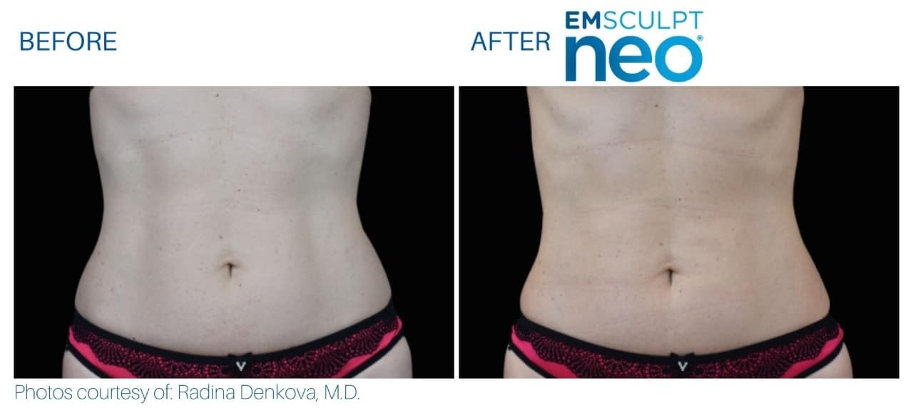Emsculpt-Neo-Before & After Treatment Photos in South Kingstown RI & Newport, RI | SeaMist MedSpa