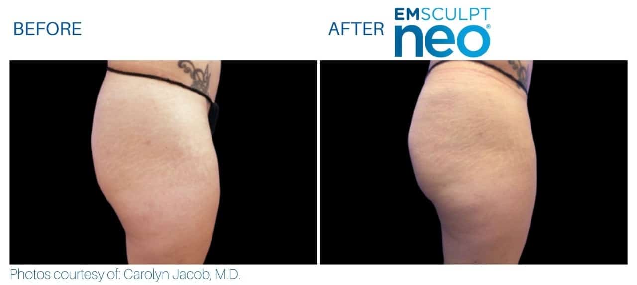 Emsculpt-Neo-Before & After Treatment Photos in South Kingstown RI & Newport, RI | SeaMist MedSpa