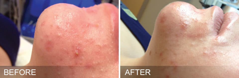 Hydrafacial Before & After Treatment Photos in South Kingstown RI & Newport, RI | SeaMist MedSpa