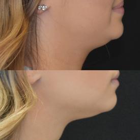 Kybella before-after Treatment in South Kingstown RI & Newport, RI | SeaMist MedSpa