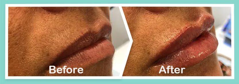 Lips before and after-Treatment result Photos in South Kingstown RI & Newport, RI | SeaMist MedSpa