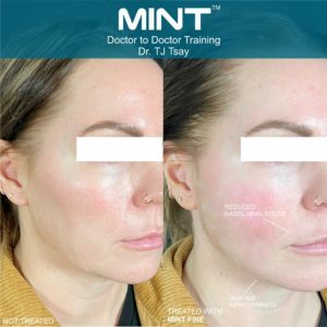 Mint-PDO Before & After Treatment Photos in South Kingstown RI & Newport, RI | SeaMist MedSpa