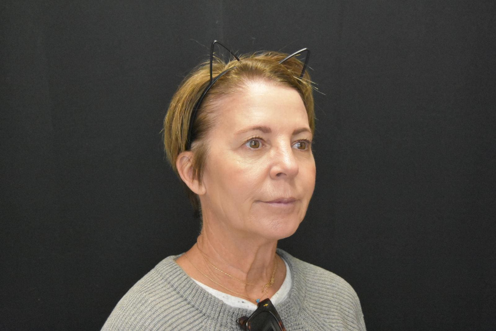 RF-Microneedling-before-after-Eleven Treatment in South Kingstown RI & Newport, RI | SeaMist MedSpa