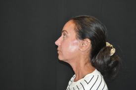 RF-Microneedling-before-after five Treatment in South Kingstown RI & Newport, RI | SeaMist MedSpa