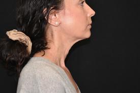 RF-Microneedling-before-after four Treatment in South Kingstown RI & Newport, RI | SeaMist MedSpa