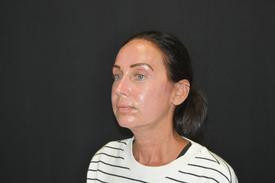 RF-Microneedling-before-after six Treatment in South Kingstown RI & Newport, RI | SeaMist MedSpa