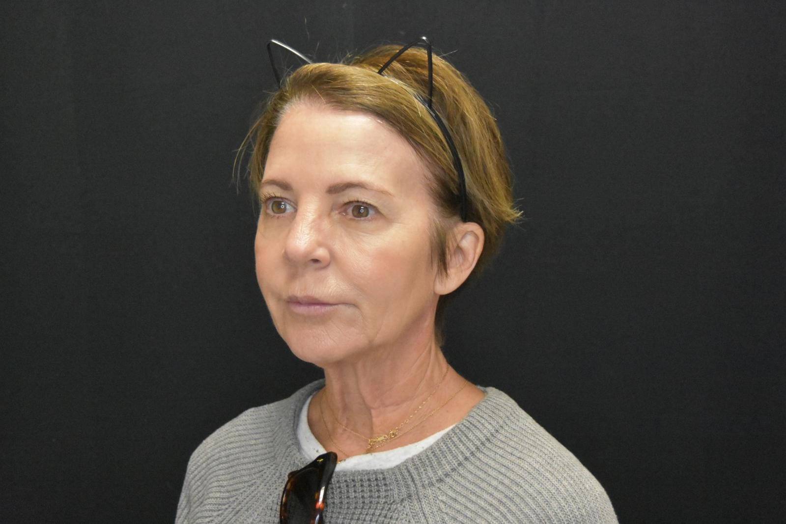 RF-Microneedling-before-after Treatment in South Kingstown RI & Newport, RI | SeaMist MedSpa