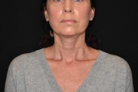 RF-Microneedling-before-after two Treatment in South Kingstown RI & Newport, RI | SeaMist MedSpa