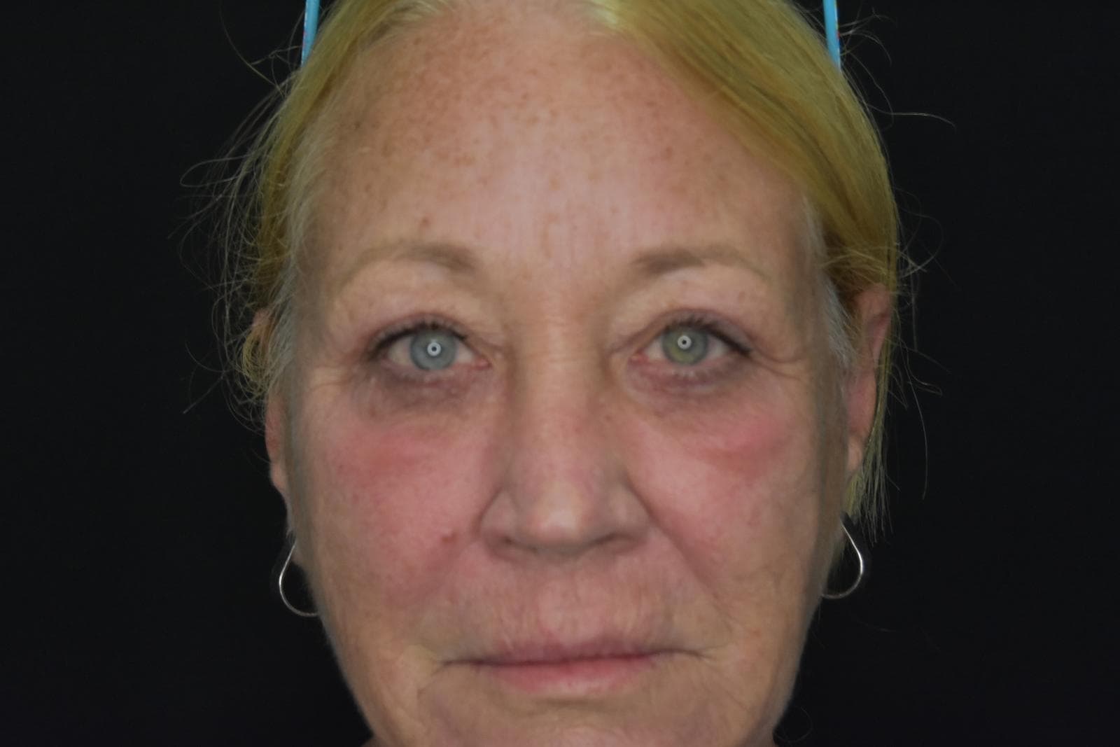 RF-Microneedling-Fifteen before-after Treatment in South Kingstown RI & Newport, RI | SeaMist MedSpa