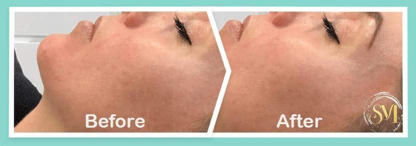 Under eyes Before and After-Treatment Photos in South Kingstown RI & Newport, RI | SeaMist MedSpa